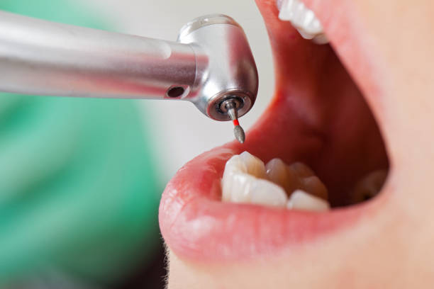 Best Emergency Wisdom Teeth Removal in Mcalester, OK